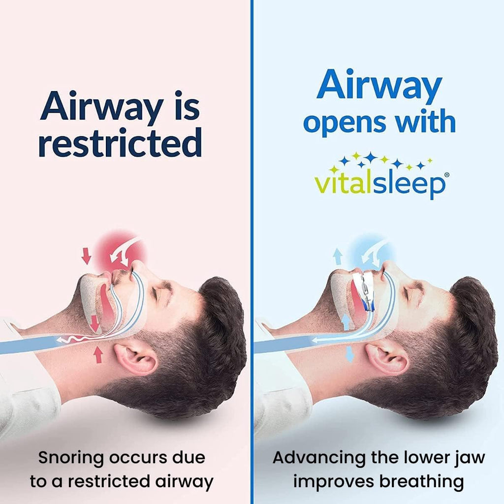 VitalSleep Anti-Snoring Mouthpiece + Sleep Mask, Custom Adjustable Jaw Positioning, USA Made & FDA Cleared Snoring Solution, BPA-Free, Comfortable Fit